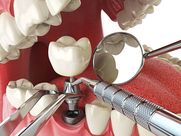 Best Emergency Tooth Extraction in Lake City, GA